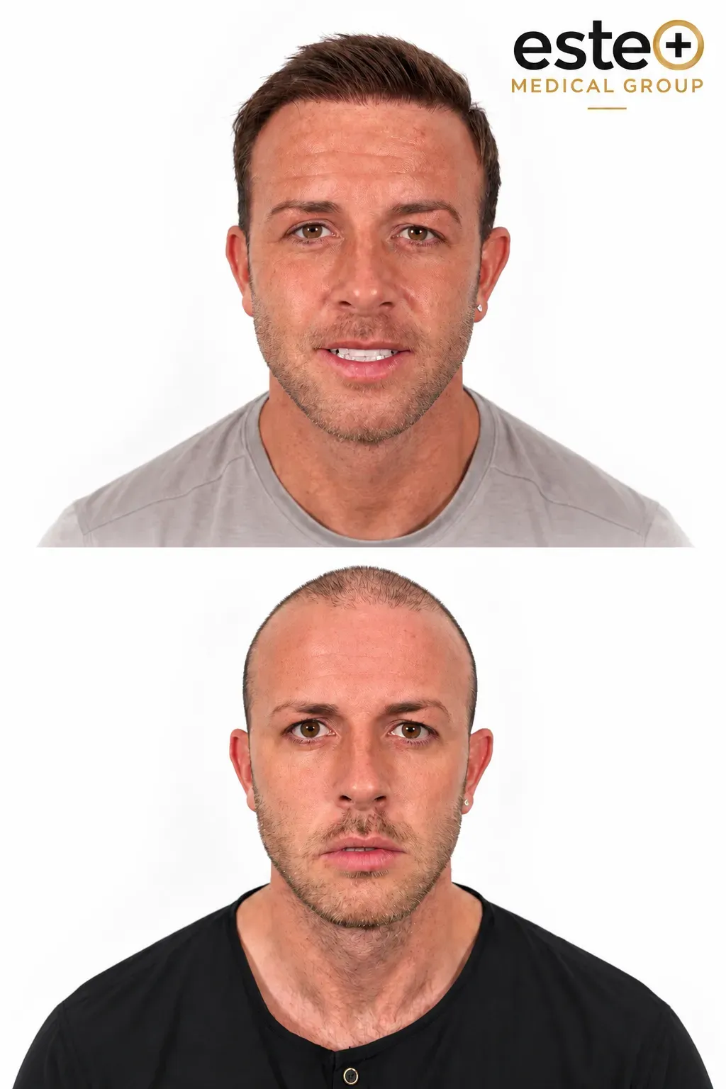 Hair Transplant results
