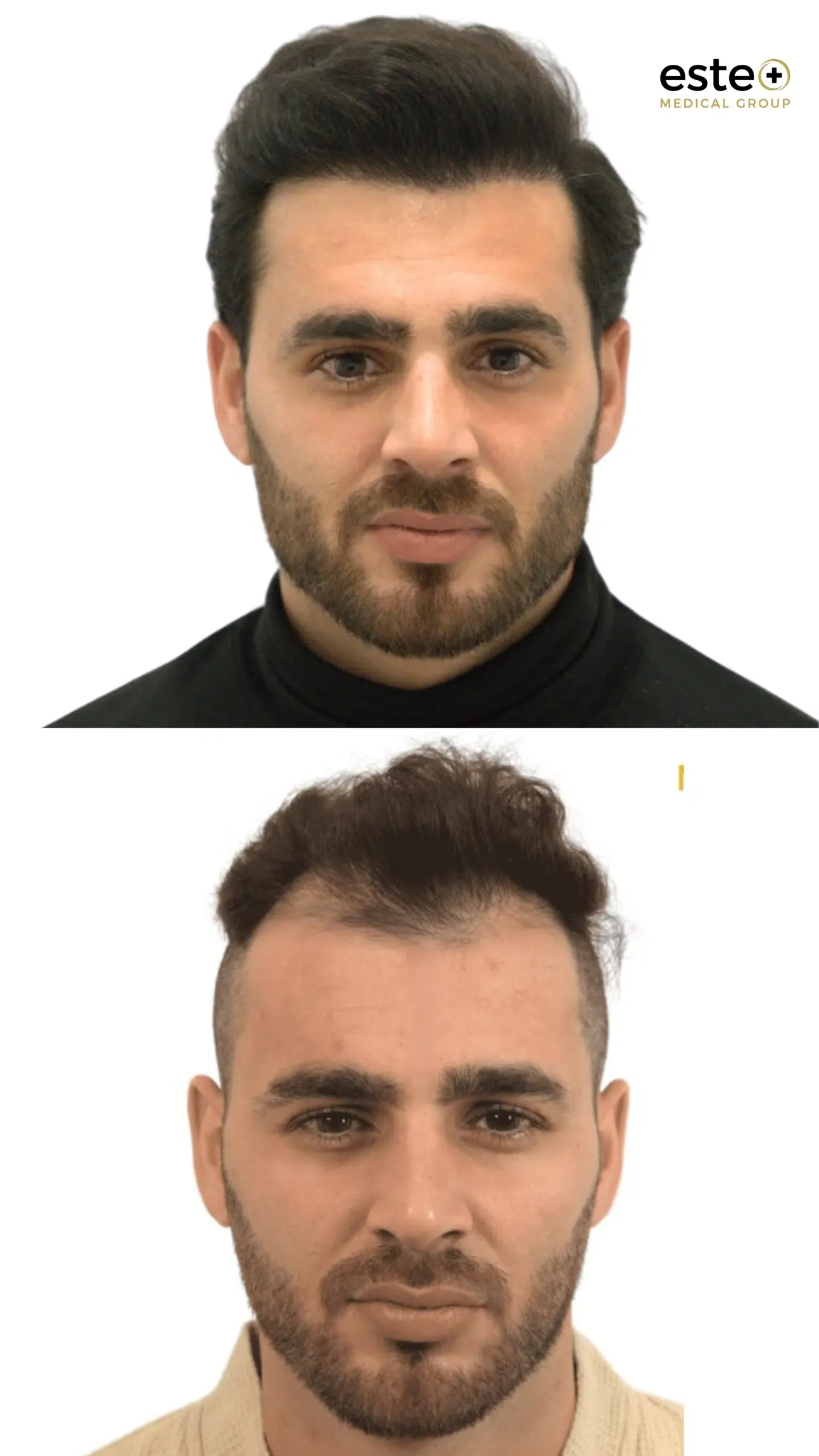 Hair transplant before and after results (increased density)