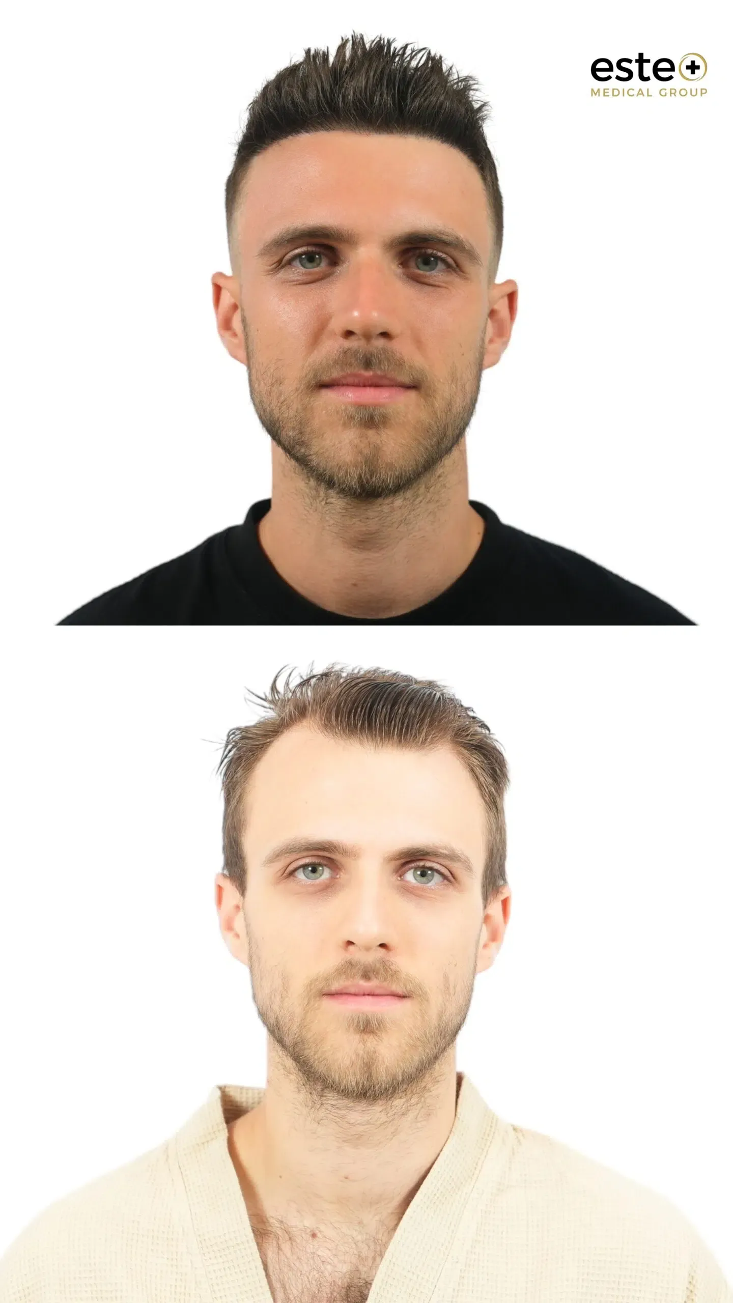 Hair transplant before and after photos (real patient results)