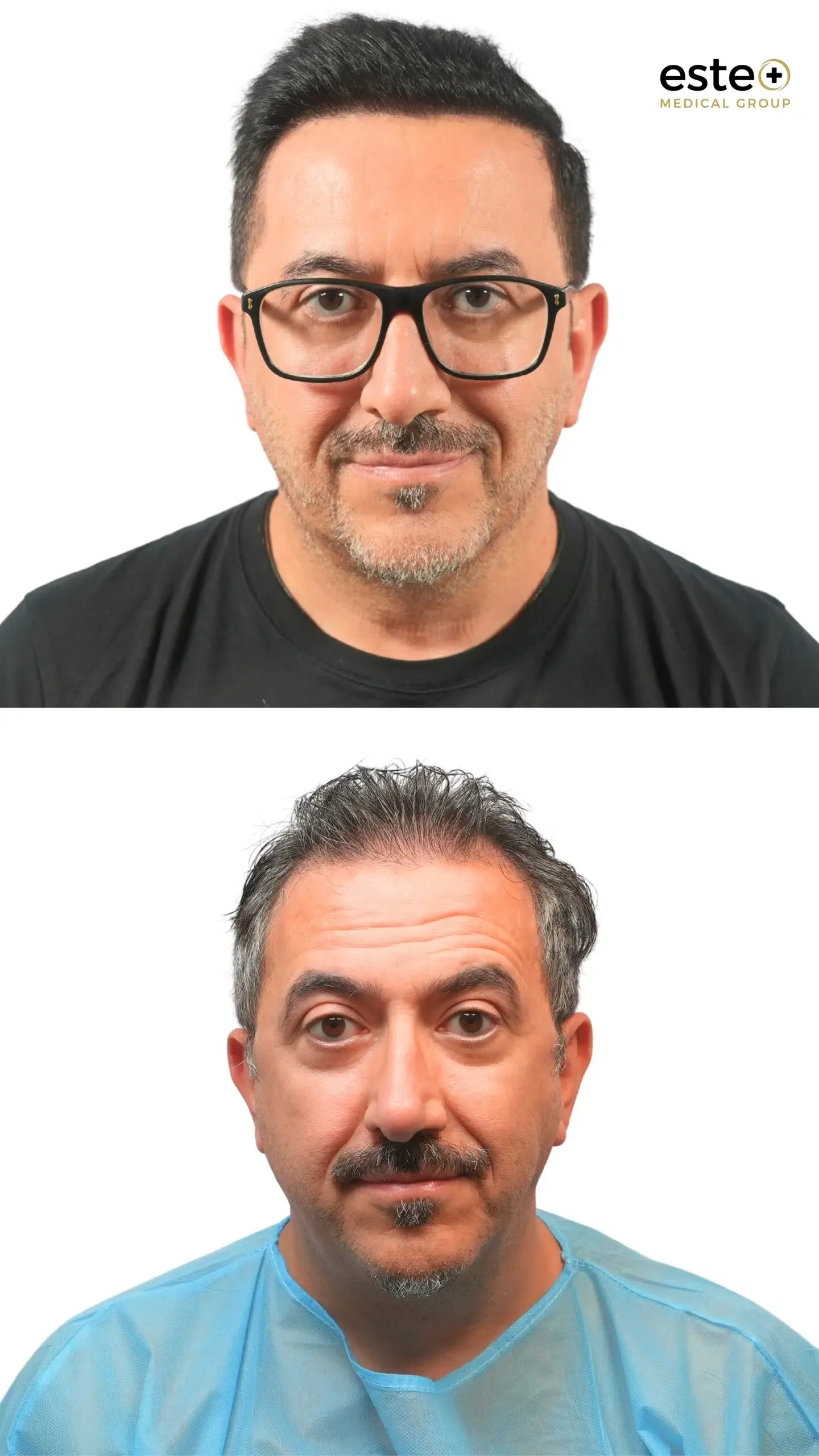 Hair transplant before and after photos (hairline restoration)