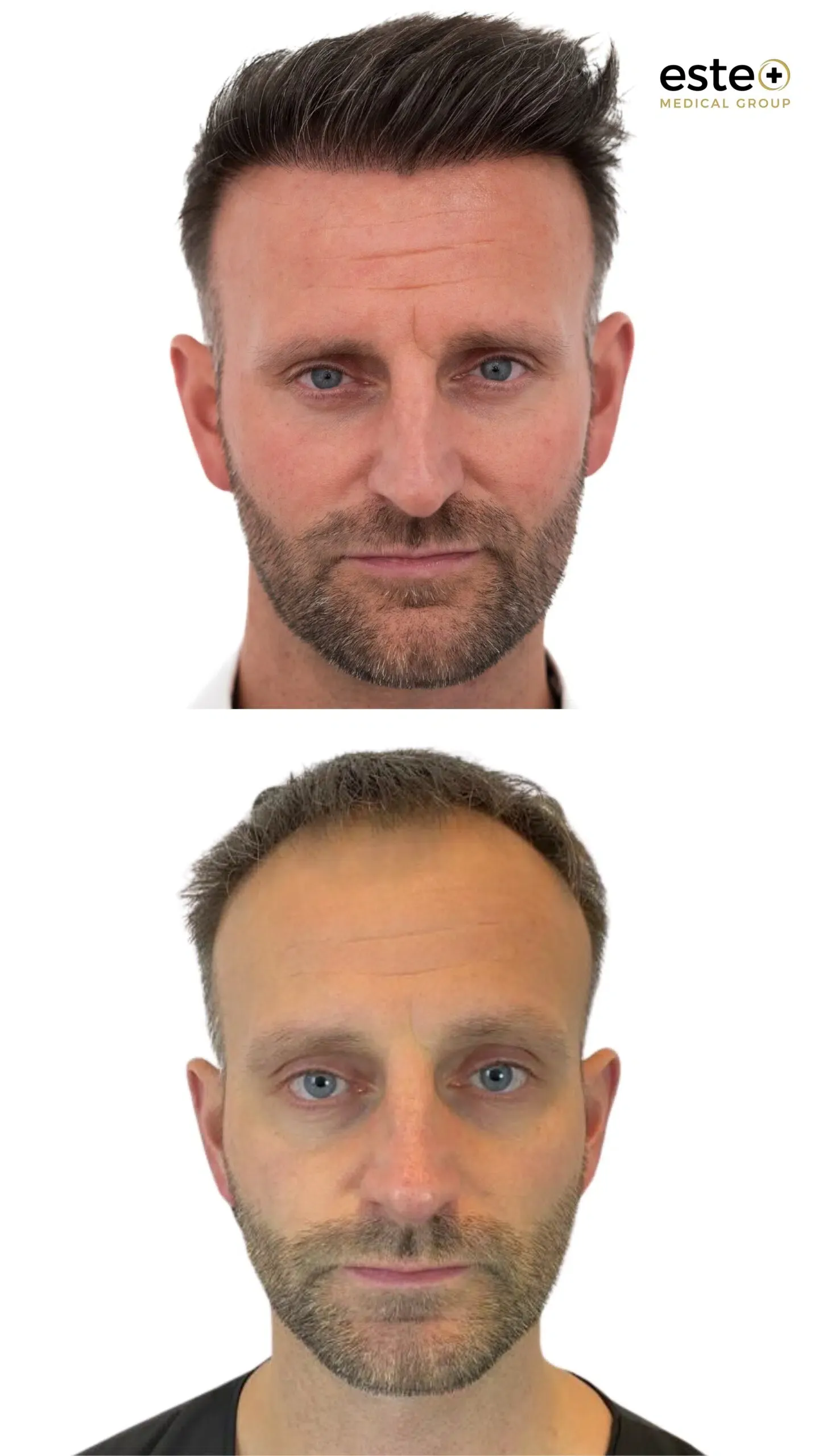 Hair transplant before and after results (improved coverage)