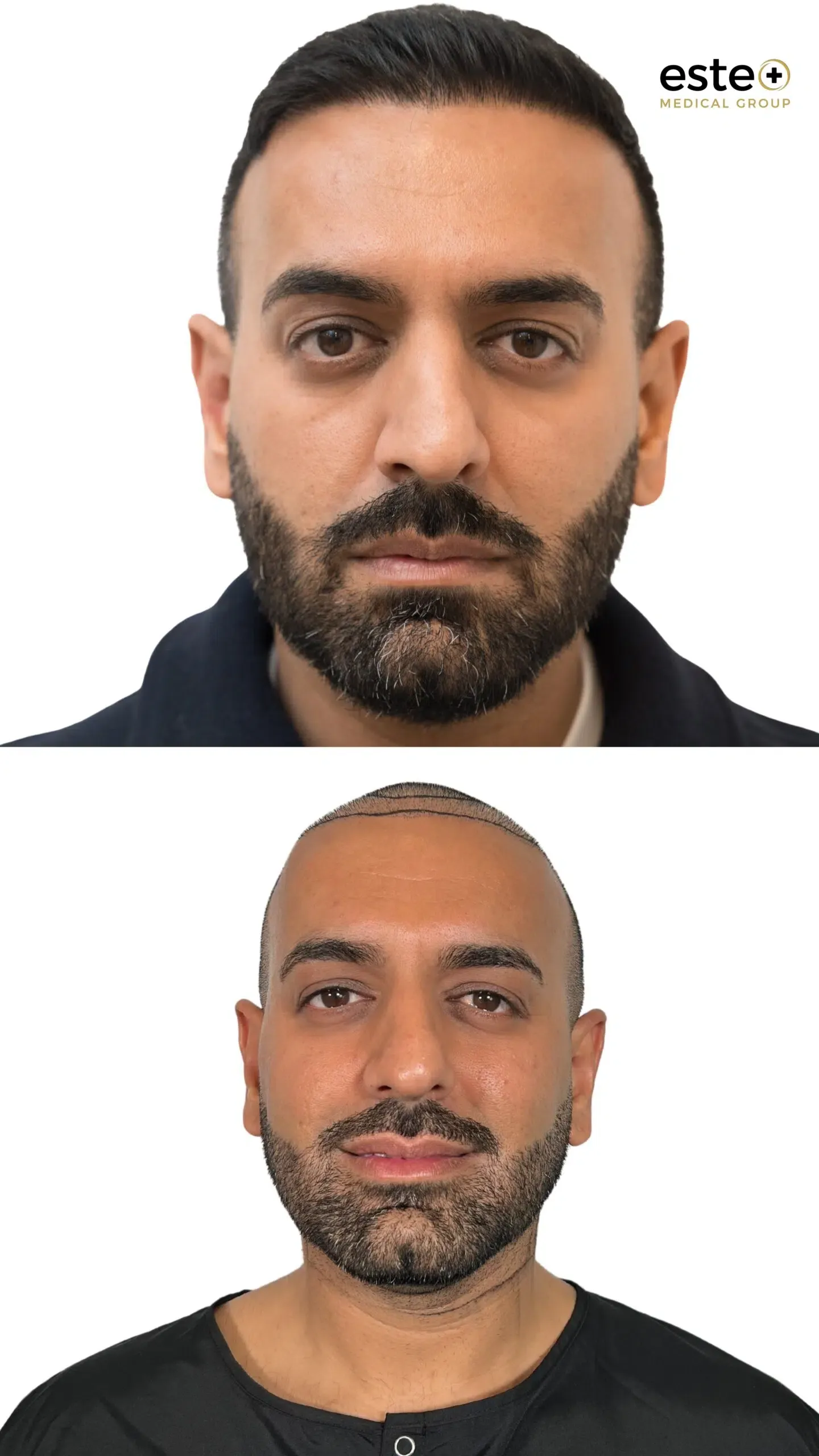 Robotic DHI hair transplant before and after results (real transformation)