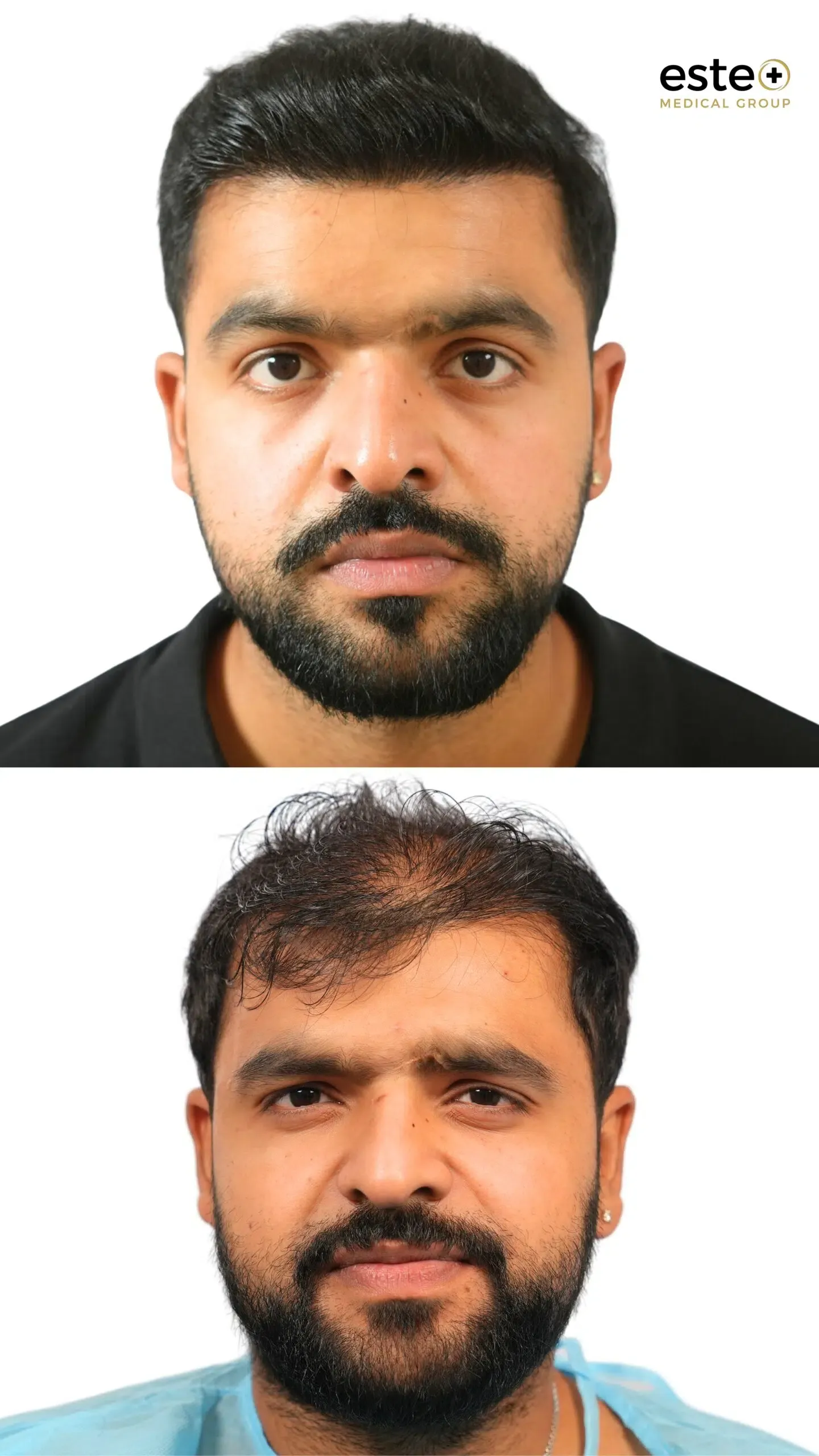 Robotic DHI hair transplant before and after photos