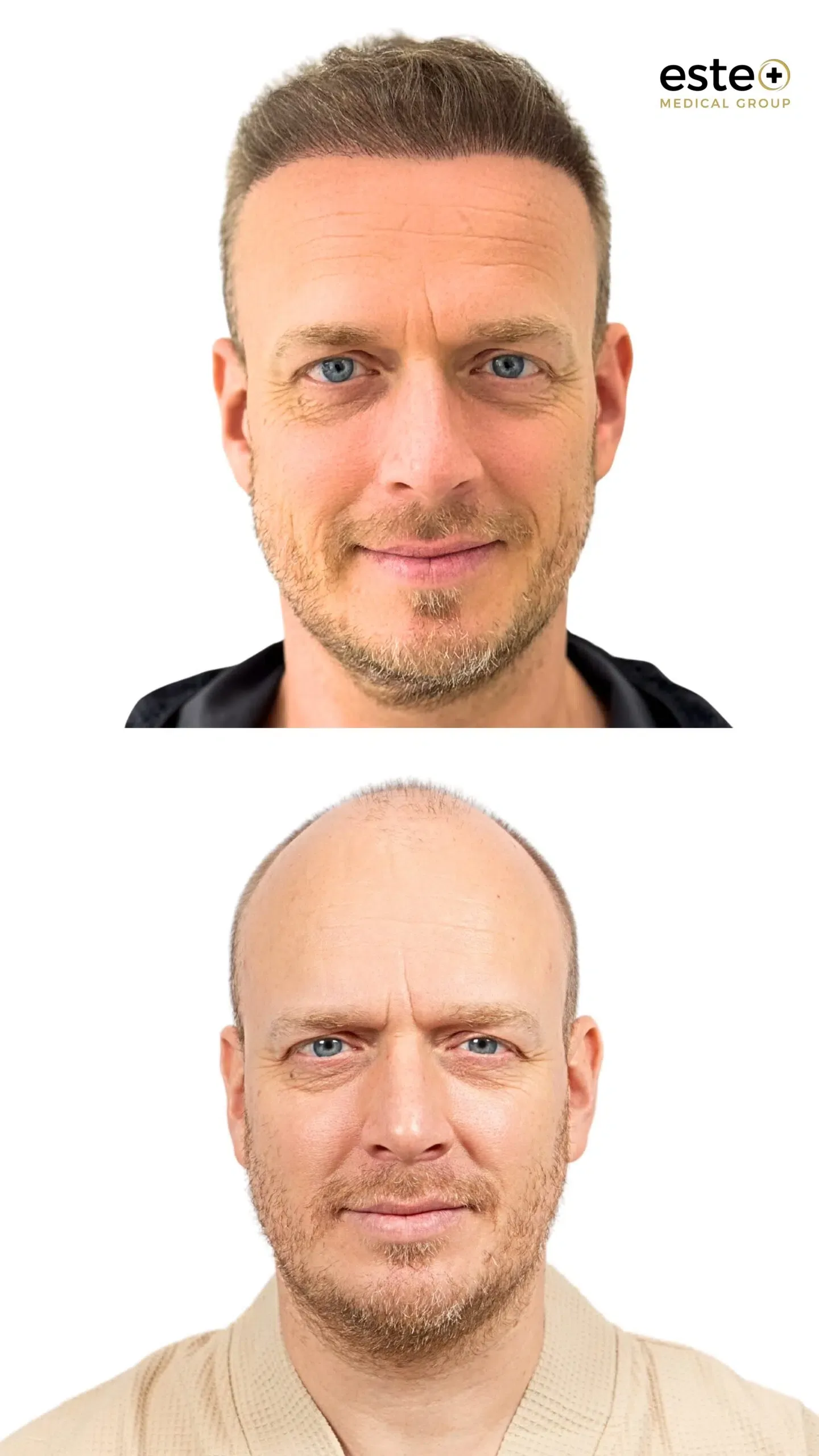 Robotic DHI hair transplant before and after photos