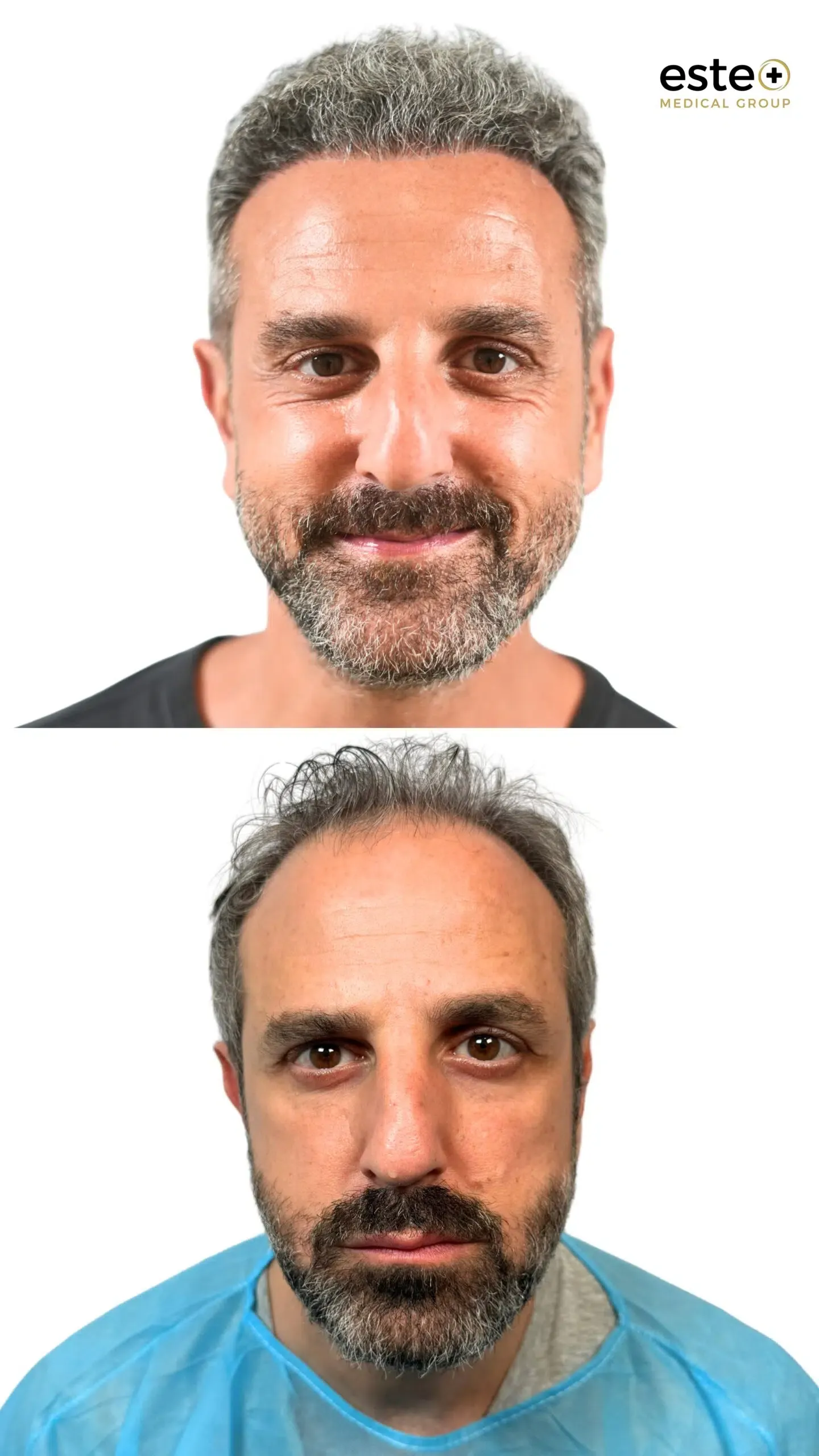 Hair transplant before and after results (visible regrowth)